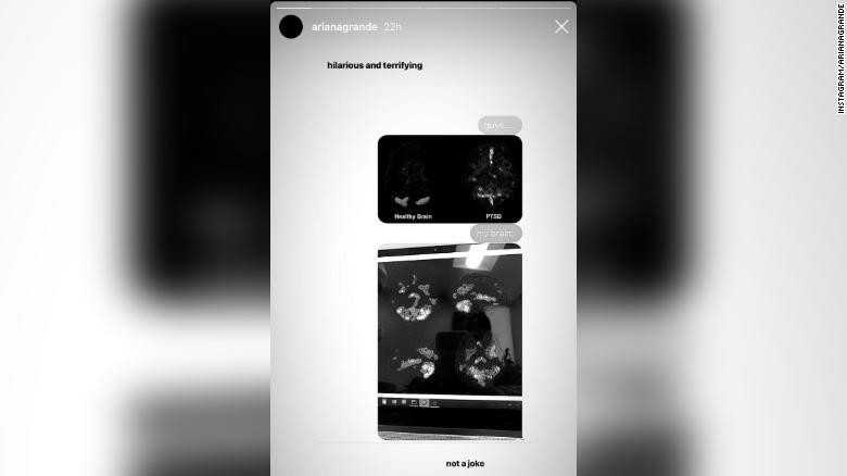 Ariana Grandes brain scan on Instagram, after speaking out about trauma on mental health.
